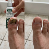 Beriberi™ Elimina hongos y picazón